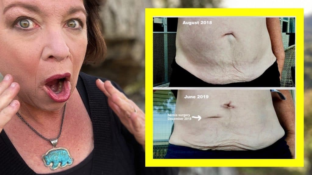 Loose Skin & Weight Loss Avoid Cosmetic Surgery, Here Are My Photos